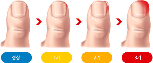 내향성발톱 증상