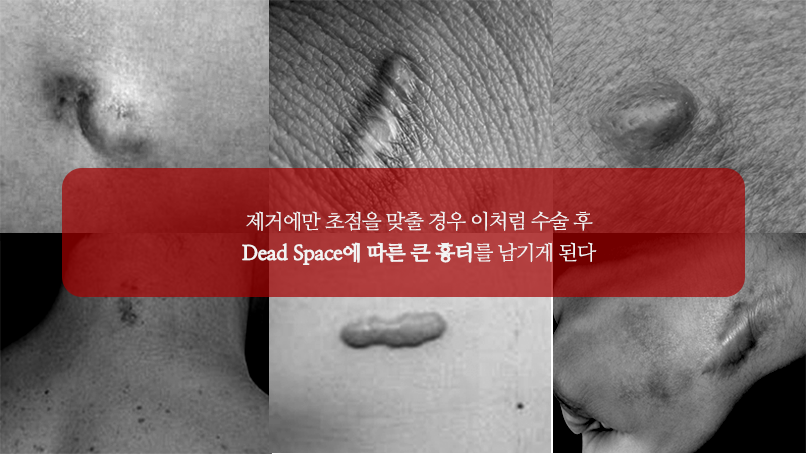 지방종의 증상3단계