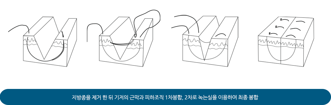 지방종을 제거한 뒤 기저의 근막과 피하조직 1차봉합, 2차로 녹는 실을 이용하여 최종 봉합